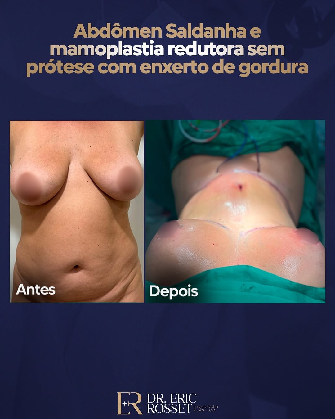 abdominoplastia-saldanha