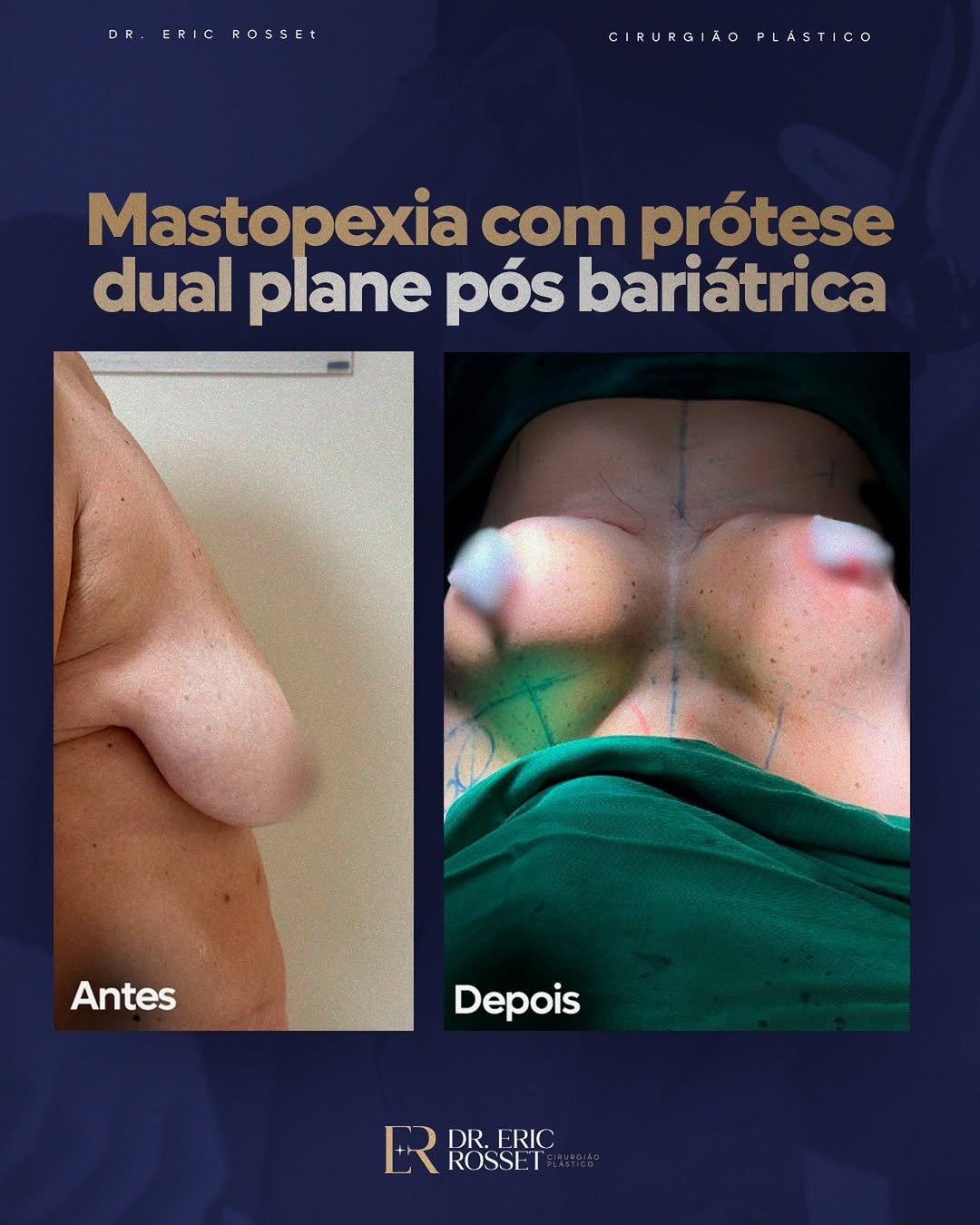 mastopexia-pos-bariatrica